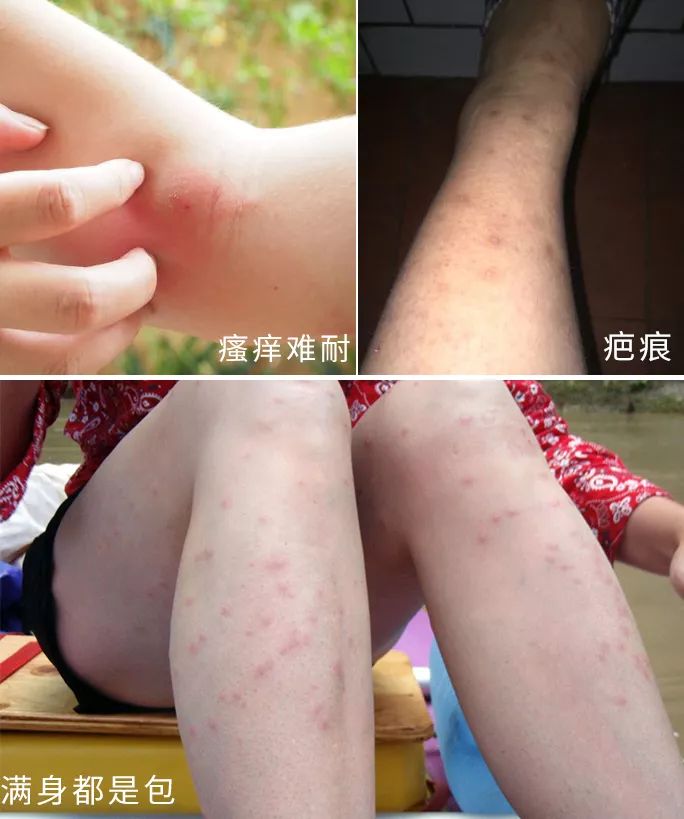 用它搞定一整夏!止痒消肿,让蚊虫再无嚣张机会