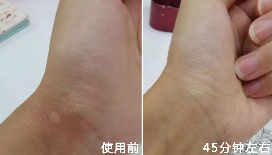 用它搞定一整夏!止痒消肿,让蚊虫再无嚣张机会