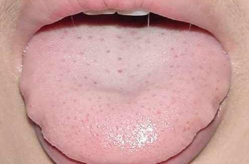 胖大舌的病机和临床表现|舌体|虚衰|病机_新浪新闻