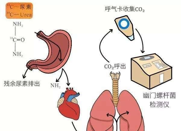 C14呼气检查幽门螺杆菌,数值高低与要不要