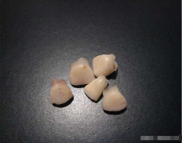 宝宝掉的乳牙,父母别再当"垃圾"扔了,关键时刻能用于"治疗"