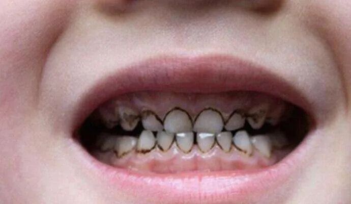 我国近4成儿童有虫牙!保护孩子牙齿,家长应该怎么做?