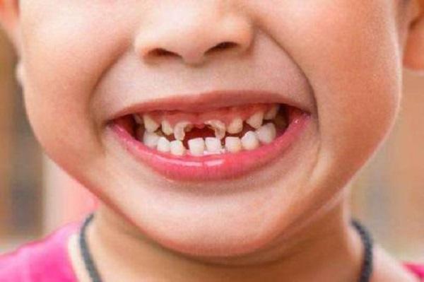 "儿童换牙期护理,需注意这5个方面|乳牙|恒牙|牙齿_新浪新闻