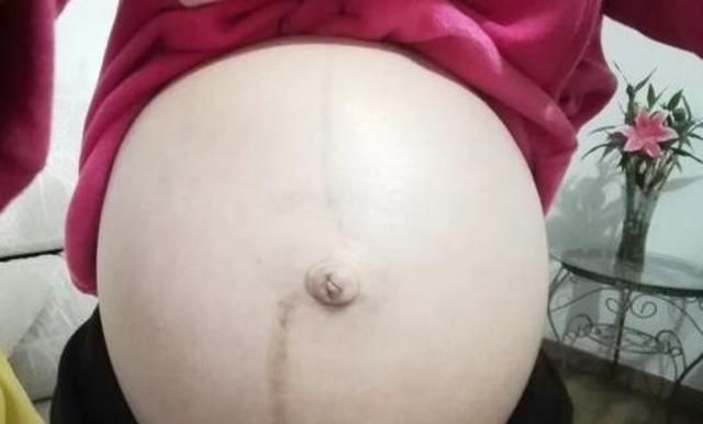 生男生女和孕肚“黑线”挂钩?妊娠线的作用远不止此,孕妈要知道