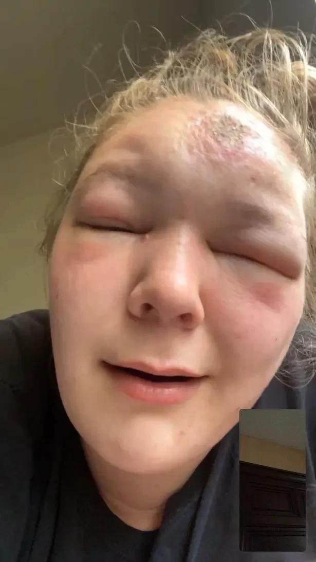 美国女子晒太阳两个小时竟阳光中毒,脸肿成包子,还差点失明