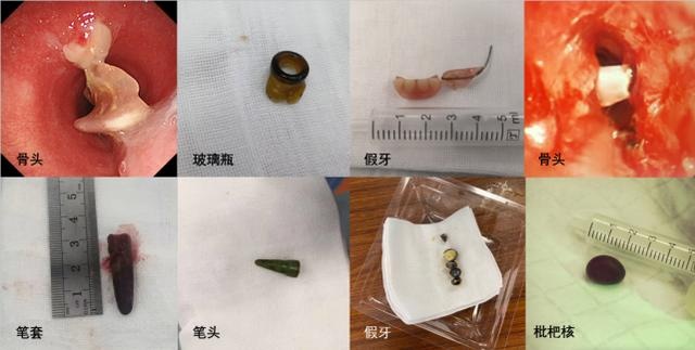80岁老伯高烧39℃、胸闷、出现阻塞性肺炎、胸腔积液,只因一颗杨梅核