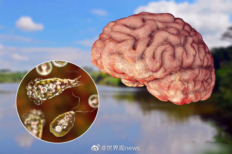 佛州的卫生官员公布了该州发现的一例食脑虫感染病例……