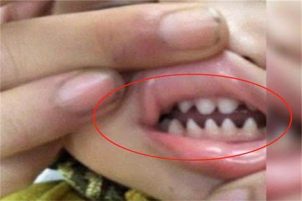 可是就在某一天刘女士检查孩子的口腔时,却发现孩子的牙齿特别尖.