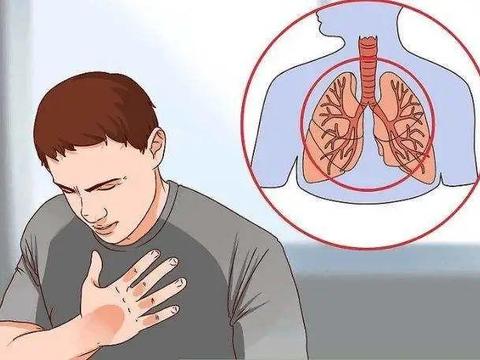 肺癌引起的咳嗽有何特点