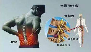 10年腰间盘突出终于好了老爸用的这一妙方摆脱了腰腿疼