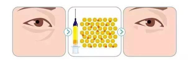 眼袋和泪沟如何区别,别再傻傻分不清