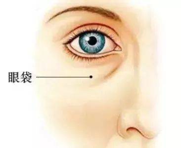 眼袋和泪沟如何区别,别再傻傻分不清