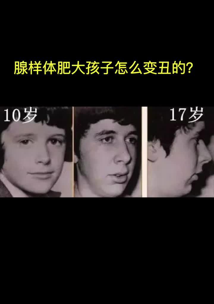 腺样体肥大引起小朋友变丑?