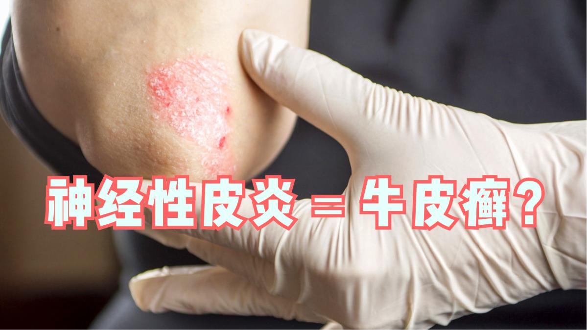 神经性皮炎和牛皮癣很像二者是一个病药师区分解答