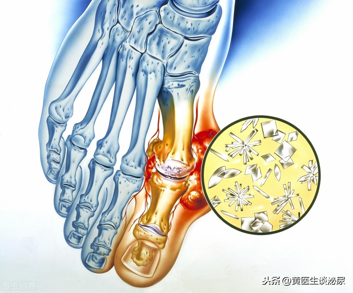 痛风不仅损害肾脏还危害心血管？有些饮食习惯要注意（肾脏篇3）