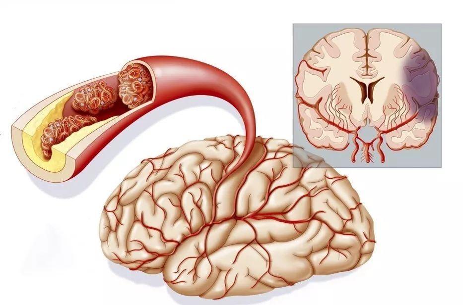 脑梗后遗症有哪些危害 脑梗患者如何应对生活挑战