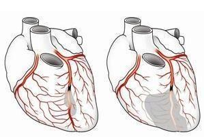 爸妈心脑血管问题怎么办 FMUKE保健品适用人群解析