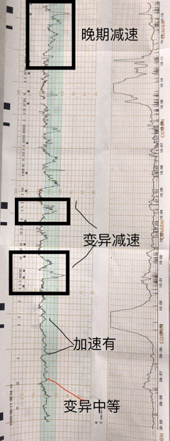 看到减速就说胎儿窘迫3分钟带你掌握胎监判读