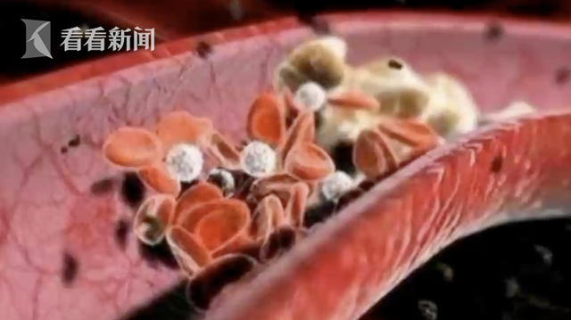 终日头昏脑胀还应酬不断 男子血中滤出半袋脂肪
