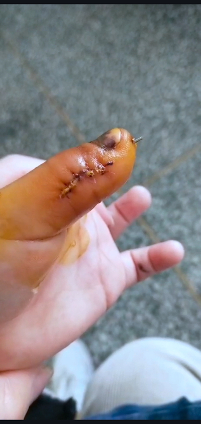 图为安徽歙县被摔打幼儿左手大拇指换药后的照片 受访者供图