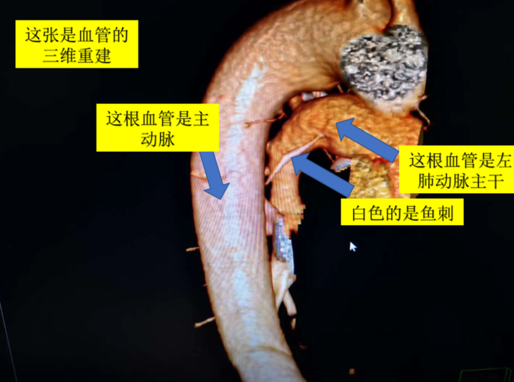 对血管结构以及鱼刺位置进行三维重建,结