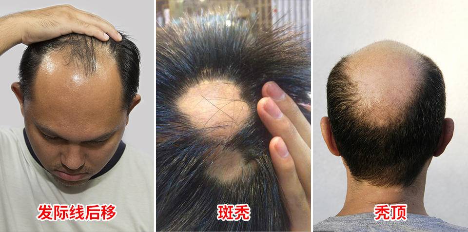 注意:脱发超过100根人群重点关注!休闲区蓝鸢梦想 - Www.slyday.coM 注意:脱发超过100根人群重点关注!休闲区蓝鸢梦想 - Www.slyday.coM