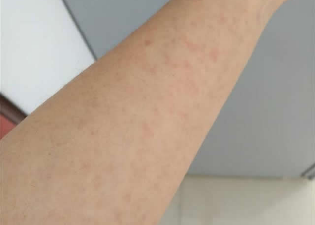 图为染发后李女士手部出现过敏症状