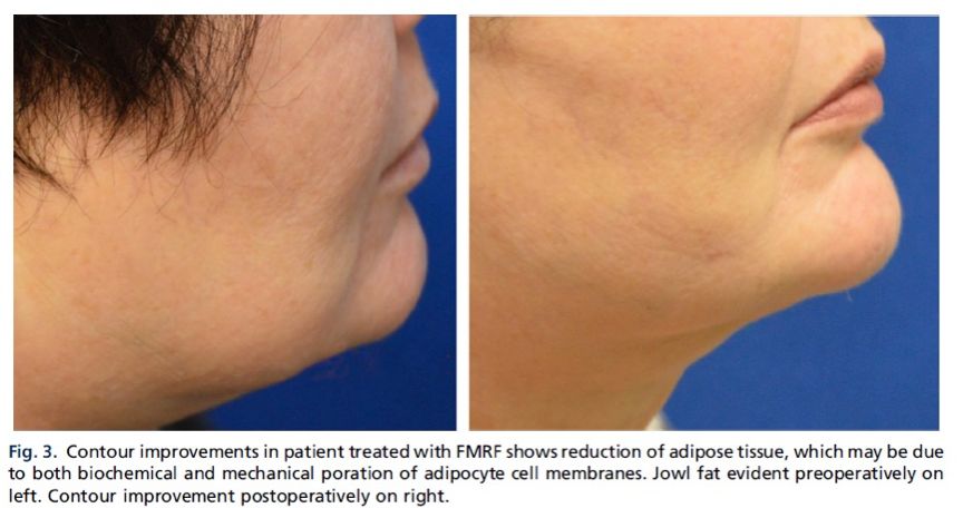 怎样可以减少体毛的增长 264d-keyancx6032113.jpg