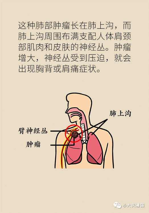 肩背痛竟然是肺癌小心这些被忽视的64肿瘤信号68