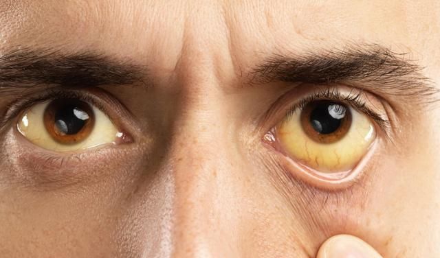 肝病早期,除了眼睛发黄,身体2处臭,有1个也要警惕