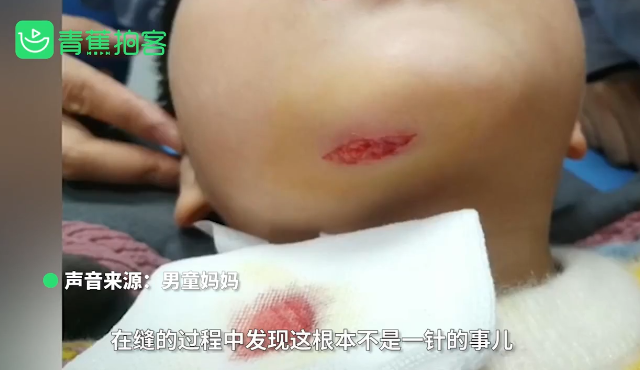 男童被幼师推倒致下巴缝八针!教育局回应休闲区蓝鸢梦想 - Www.slyday.coM 男童被幼师推倒致下巴缝八针!教育局回应休闲区蓝鸢梦想 - Www.slyday.coM