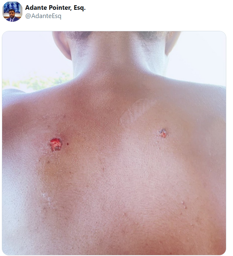 普恩特在推特上发布该少年的伤口照片