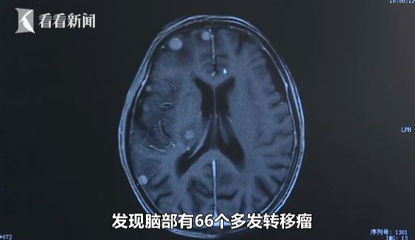 医生发现伍老伯脑部有66个多发转移瘤，它分布在颅内，脑干、还有左右大脑半球。