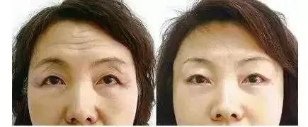 玻尿酸解决静态皱纹,肉毒素对付动态皱纹,你适合哪个?