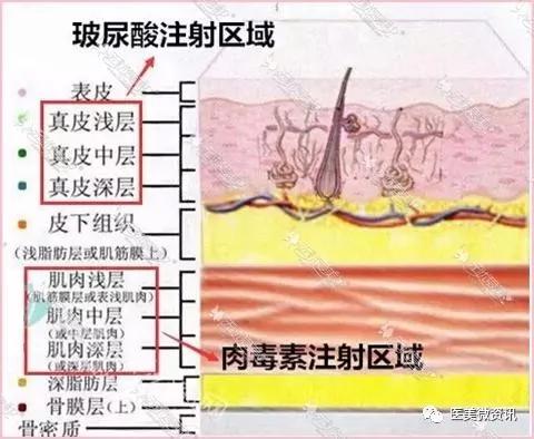 玻尿酸解决静态皱纹,肉毒素对付动态皱纹,你适合哪个?