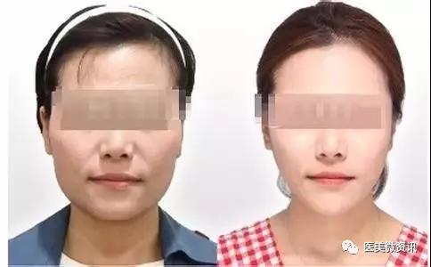玻尿酸解决静态皱纹,肉毒素对付动态皱纹,你适合哪个?