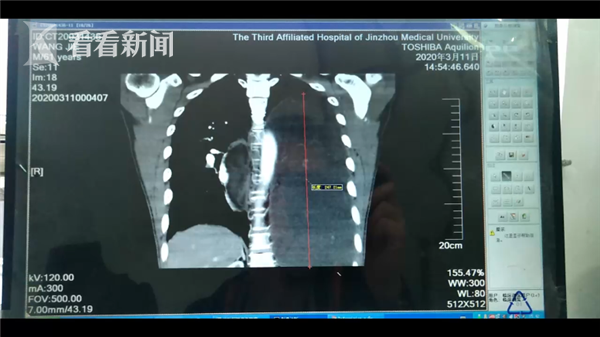 阑尾炎症状表现有哪些视频 a368-irkazzv8006783.png
