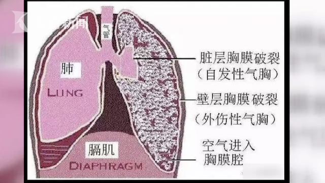 45岁男子因过敏连续打喷嚏 肺泡破了