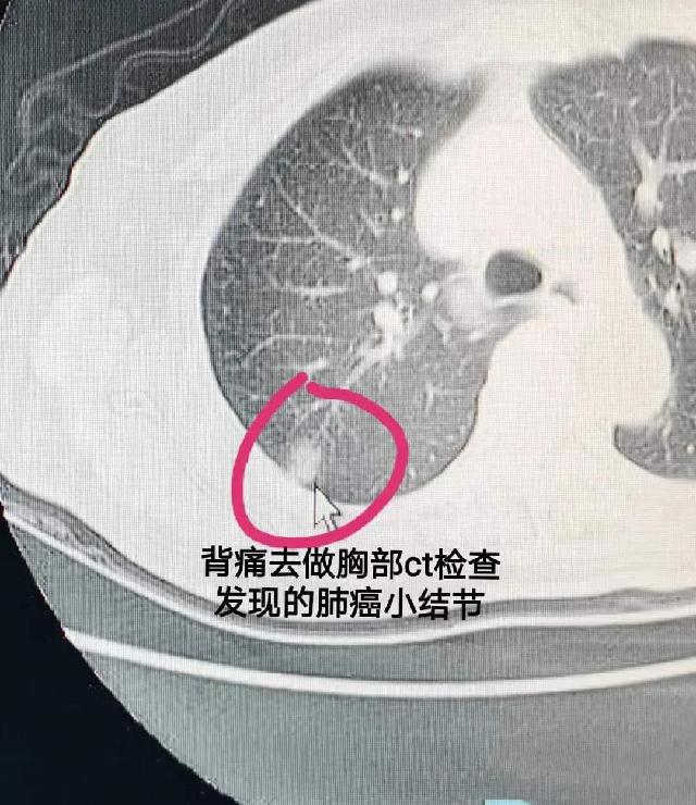 不查不知道一查救一命痰液肺癌基因甲基化早发现早诊断