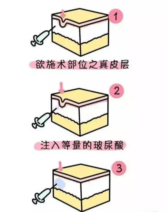 20岁的脸,30岁的颈纹!!!你知道颈部皮肤衰老比面部更难修复吗?
