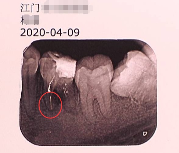 江门女子治疗蛀牙后疼了一星期 竟有断针留在牙中