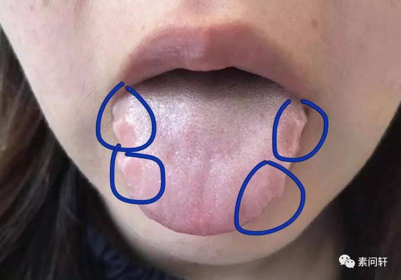 舌头有齿痕,是湿气重吗?这个问题90%的人都理解错了!