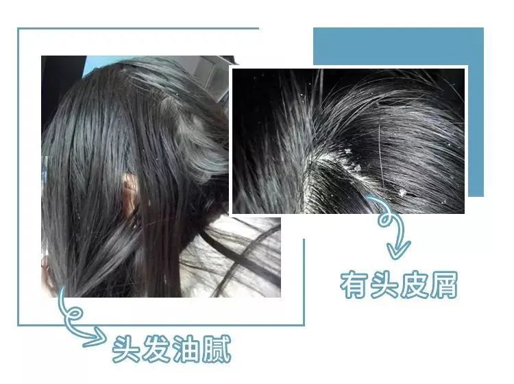 买一送一 | 3天不洗头也不痒!国家专利氨基酸洗发水,固发还强效去头屑