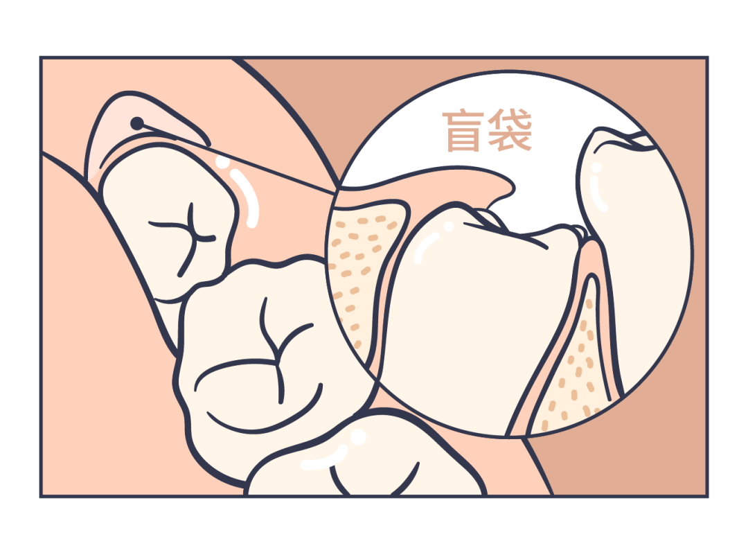 为什么这六类智齿一定要拔拔了能瘦脸吗一文讲清楚