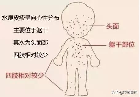 水痘发病较急,年长儿童和成人在皮疹出现前可有发热,头痛,全身倦怠