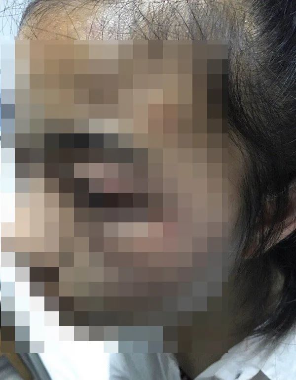 彭俊媛遭受欺凌后面部曾出现明显红肿 家属供图