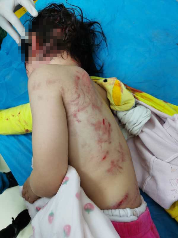 广西一4岁女童小区内被狗撕咬遍体鳞伤
