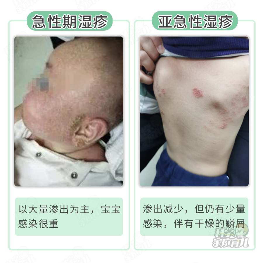 紧急停用!又一网红宝宝霜出事了!60%湿疹不要用药!