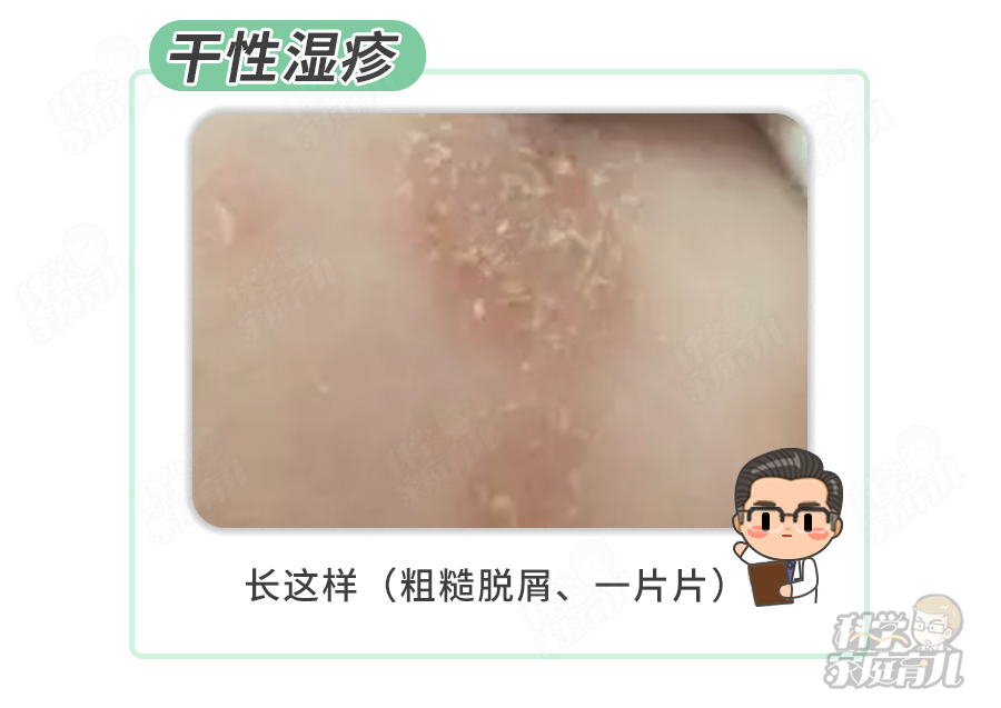 紧急停用!又一网红宝宝霜出事了!60%湿疹不要用药!
