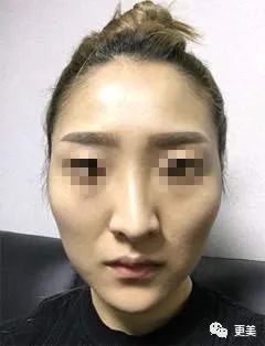 你分得清自己是颧骨突出还是太阳穴凹陷吗?二者到底怎样区分?